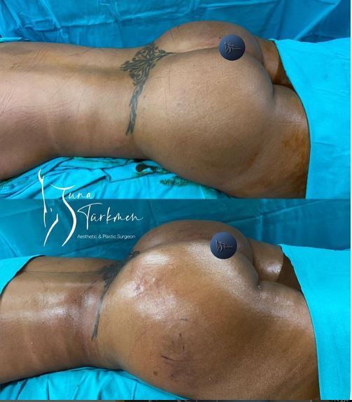 Brazilian Butt Lift Surgery