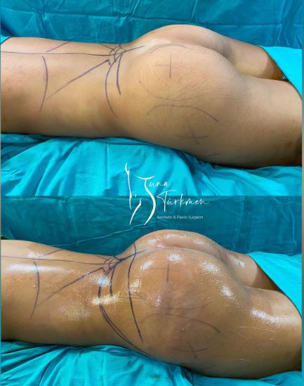 Brazilian Butt Lift Surgery