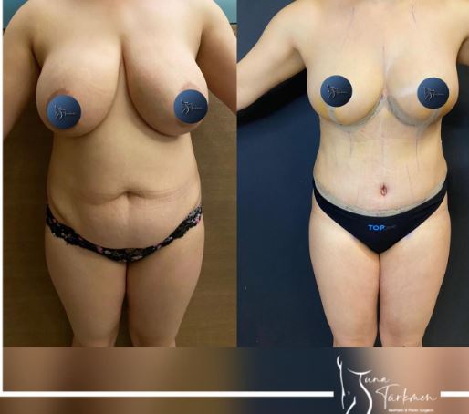 liposuction surgery before and after being operated on by Tuna Turkmen