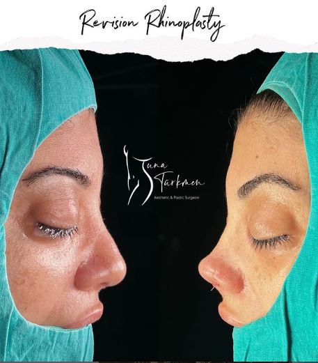 Revision-Rhinoplasty surgery in Turkey Istanbul