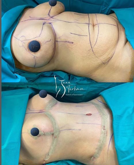 a patient of abdominoplasty-tummy-tuck and breast reduction surgery in Istanbul Turkey