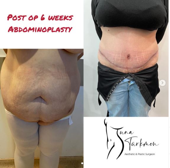 a patient of abdominoplasty-tummy-tuck surgery in Istanbul Turkey