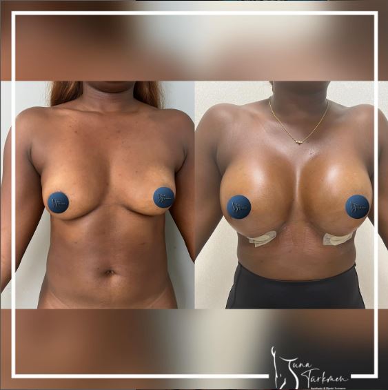 What are the risks associated with breast augmentation?in turkey, istanbul