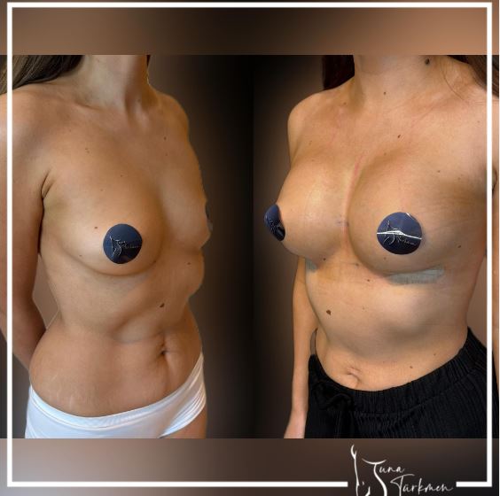 Who is good candidate for breast augmentation?