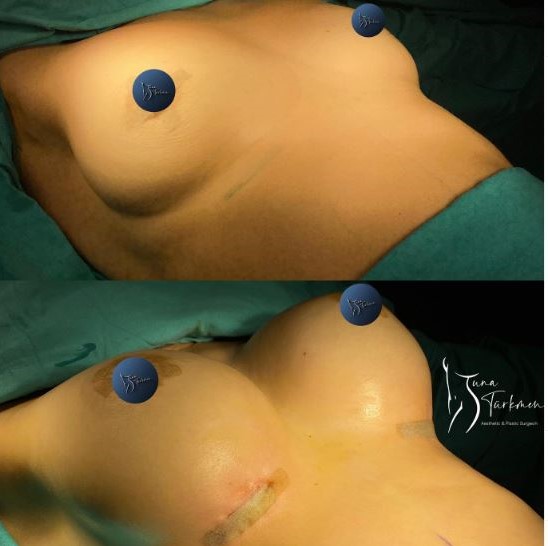 surgeon Tuna Turkmen; breast-augmentation with implant-before-after-istanbul-turkey