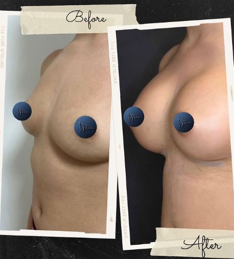 breast-augmentation with implant-istanbul-turkey