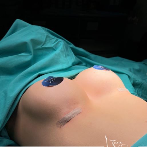 breast-augmentation