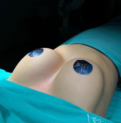 breast-augmentation