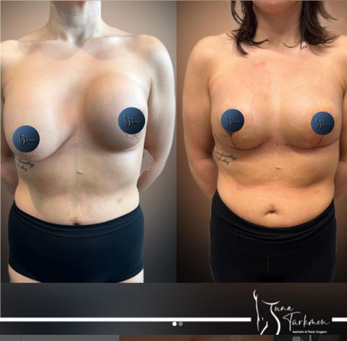 Breast Asymmetrical Correction-istanbul-turkey