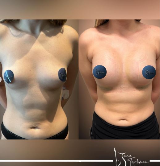 breast enlargement is safe in Turkey