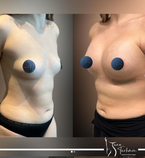 breast enlargement is safe in Turkey