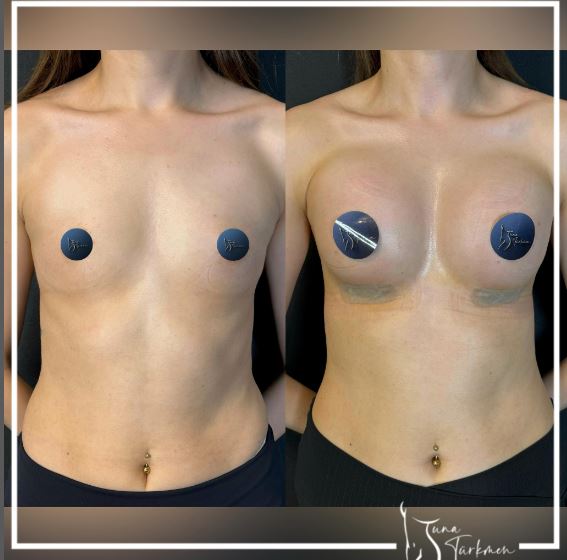 breast-enlargement-istanbul-turkey