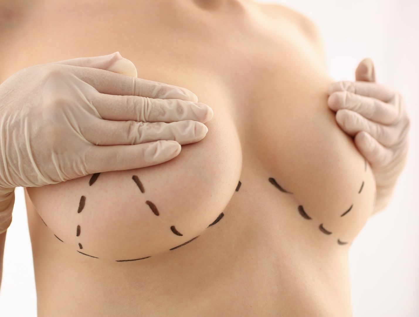 How common are the complications and risks of a mastopexy breast lift? -istanbul-turkey