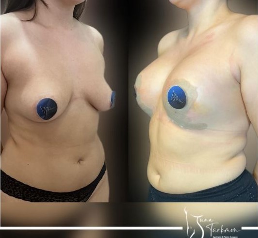 breast-lifting before and after surgery