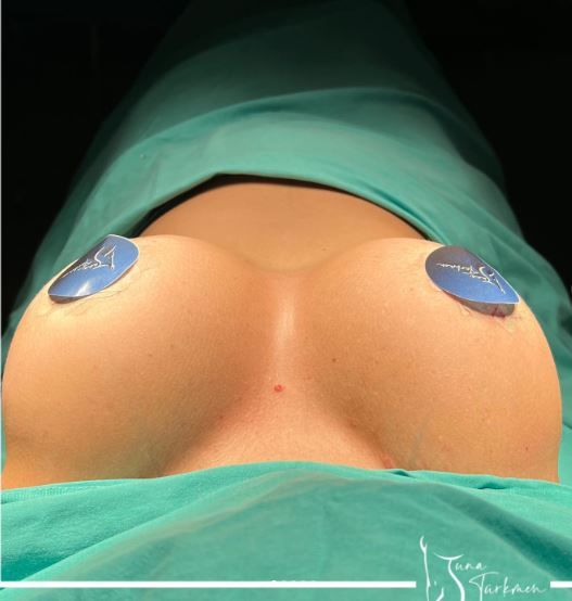 Breastlifting with implant, 355 cc round high profile implants were used-istanbul-turkey