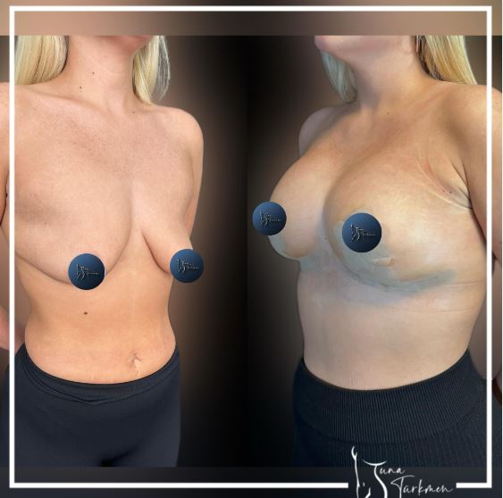 breast-lift-with-implant