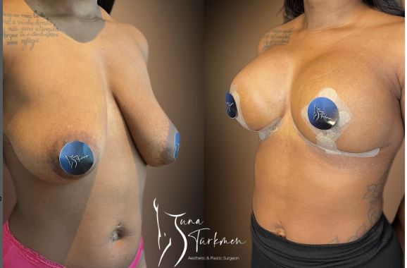 Breast Lift with silicone gel implant surgery