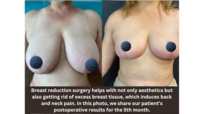 breast-reduction