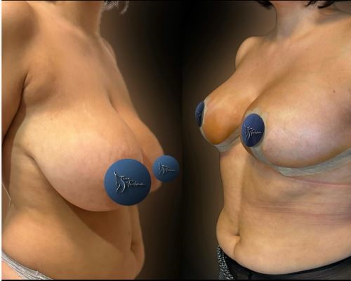 breast-reduction-surgery