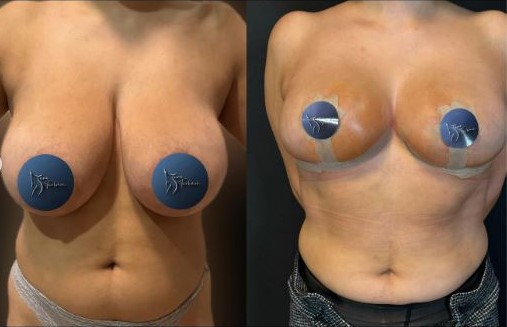 breast-reduction-surgery