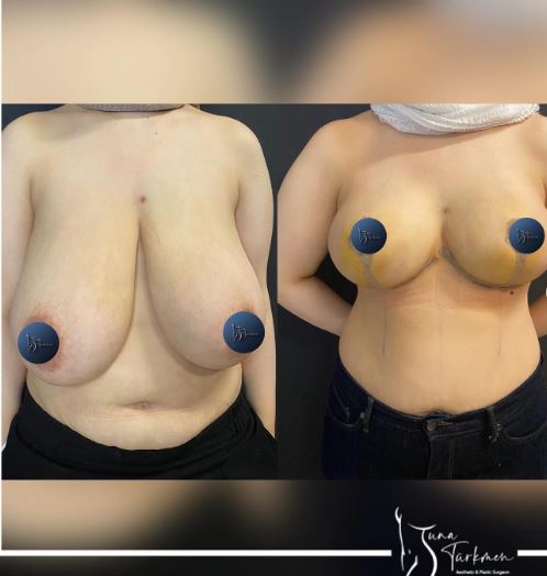 What are pros and cons of breast reduction? in Istanbul Turkey