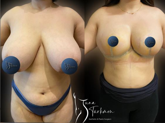 breast-reduction