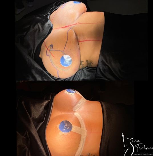 Breast Reduction Surgery