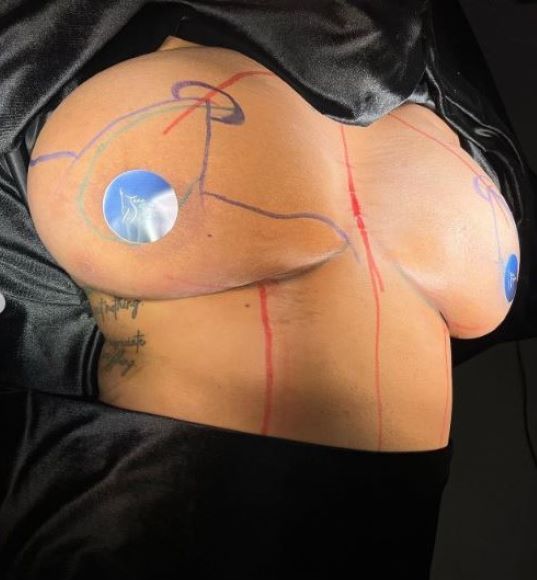 breast-reduction-surgery