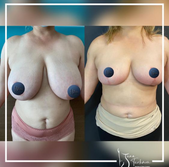 Can I not use a bra after Breast Reduction surgery?-turkey