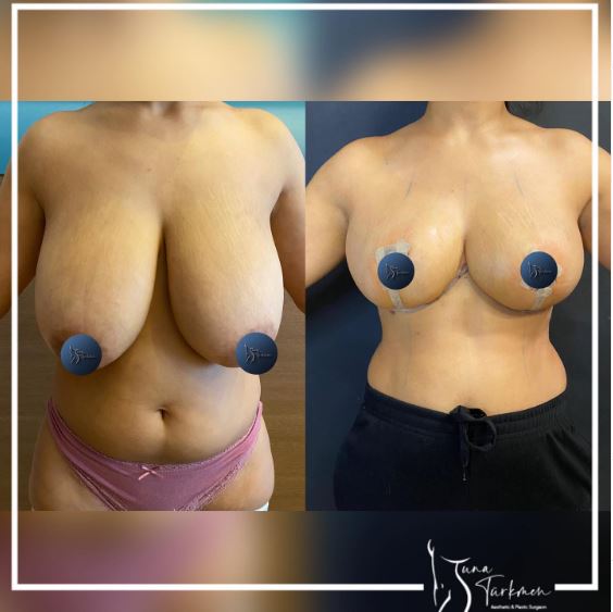 FAQ's about breast reduction surgery in Turkey Dr.Tuna Turkmen