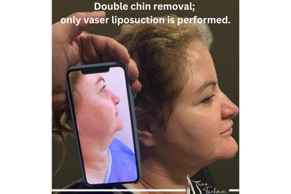 Double chin removal