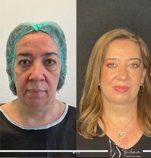 Deep Plane Facial Lift turkey-istanbul