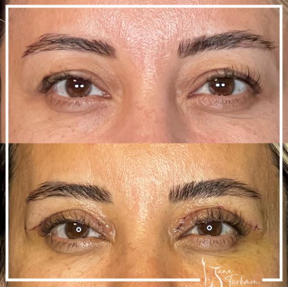 getting rid off excess upper eyelid tissue with upper blepharoplasty surgery