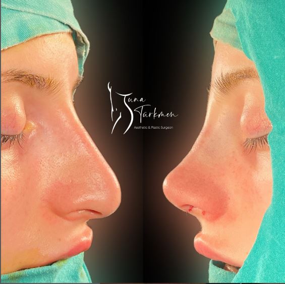 How do I prepare for rhinoplasty? in Turkey, Istanbul