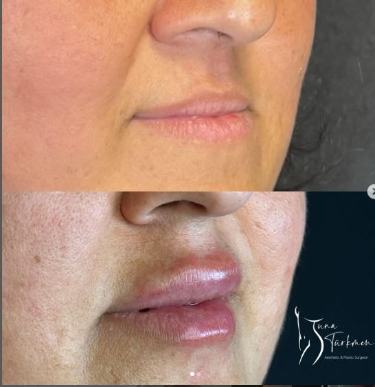 lip-filling-before-after in Istanbul Turkey