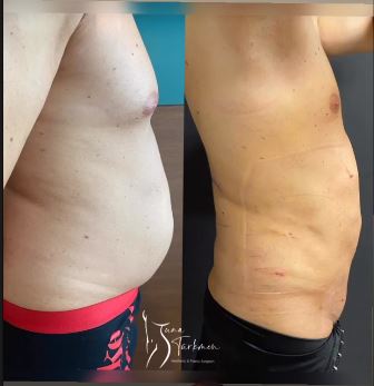 liposuction surgery before and after being operated on by Tuna Turkmen