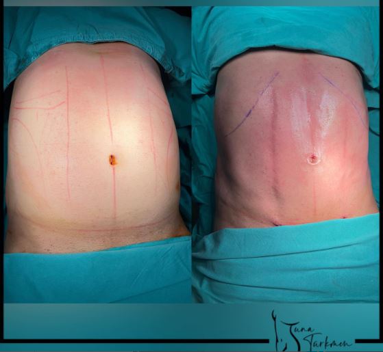 liposuction surgery before and after being operated on by Tuna Turkmen