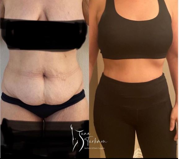 liposuction surgery before and after being operated on by Tuna Turkmen