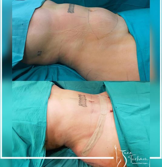 liposuction-fat removal