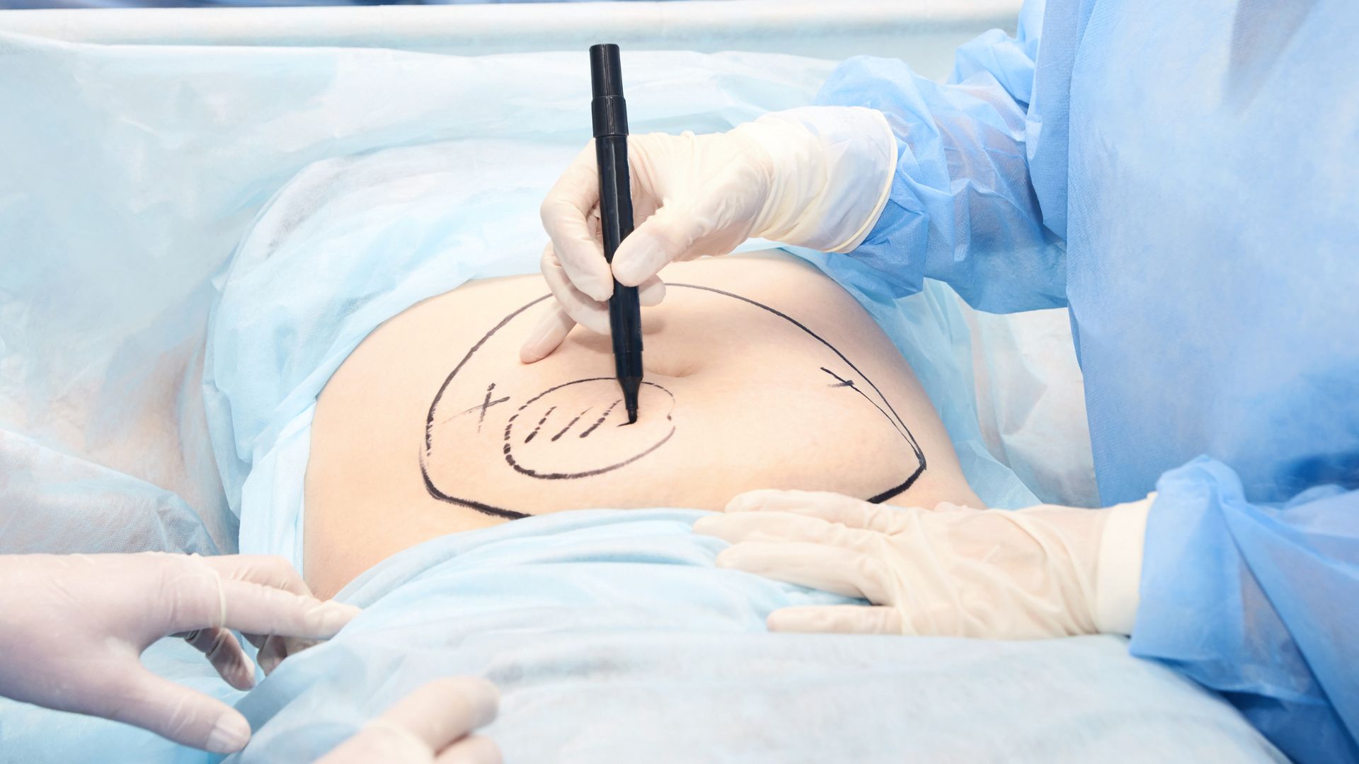 What is the difference between liposuction and a tummy tuck?