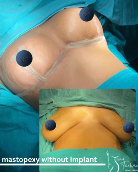 mastopexy-without-implant istanbul-turkey