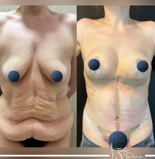 mommy-makeover-surgery-before-after-turkey