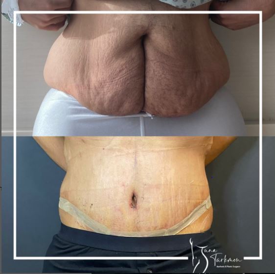 post-bariatric-abdominoplasty in Istanbul Turkey