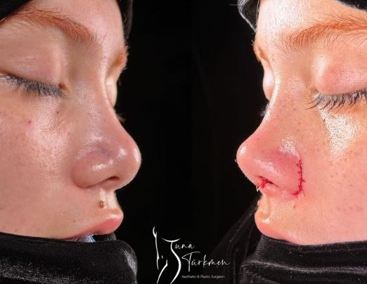 Revision Rhinoplasty-Barbie Nose  in Istanbul Turkey