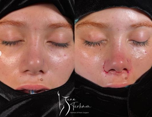 Revision Rhinoplasty-Barbie Nose  in Istanbul Turkey