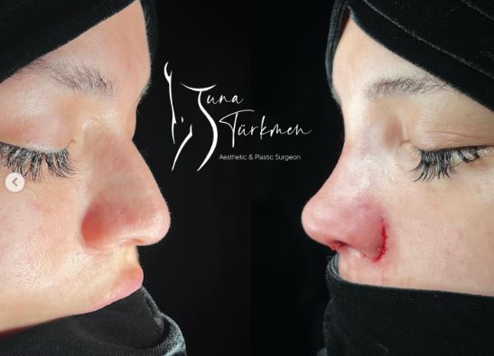 Ultra Thick Skin Rhinoplasty