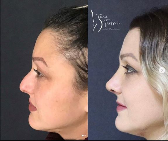 rhinoplasty surgery before-after in Istanbul Turkey