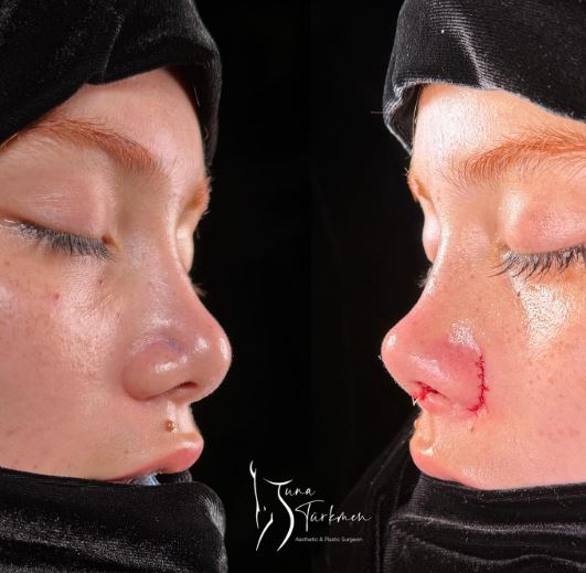 how-is-rhinoplasty-surgery-done-turkey-istanbul