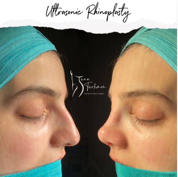 a canditate for ultrasonic rhinoplasty in Istanbul Turkey