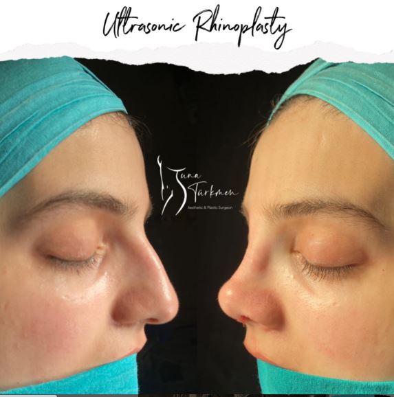 How long does swelling last after nose job / rhinoplasty? in Turkey, Istanbul